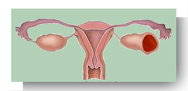 grossesse extra uterine ovarienne