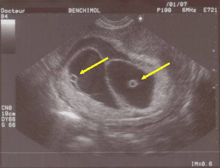 grossesse gemellaire deux vesicules vitellines
