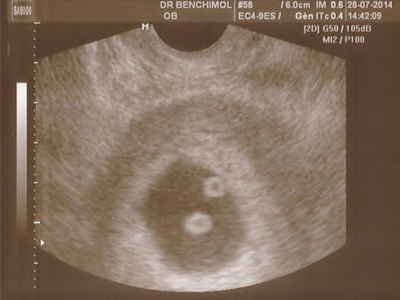 grossesse gemellaire monoamniotique 1