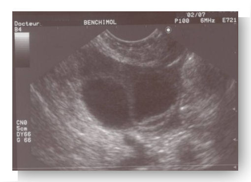 monitorage ovulation pauci folliculaire