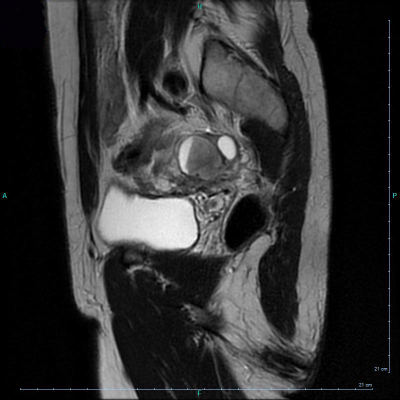 irm kyste endometriosique