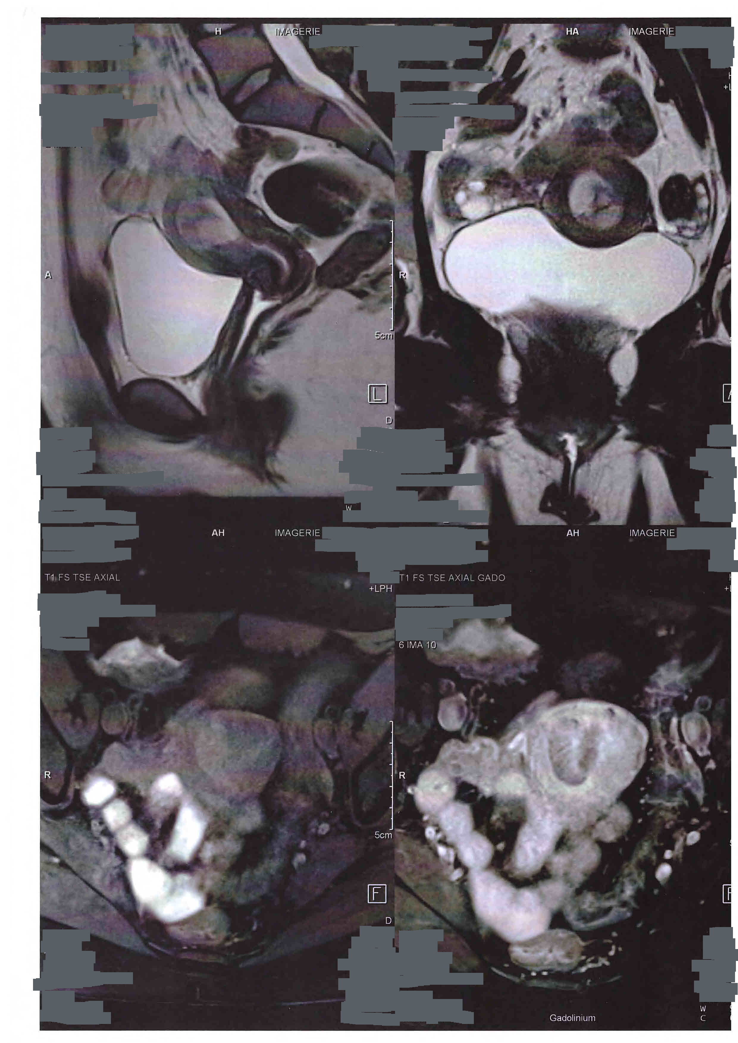 Ménorragies - Métrorragies - Docteur Benchimol : Gynécologue ...