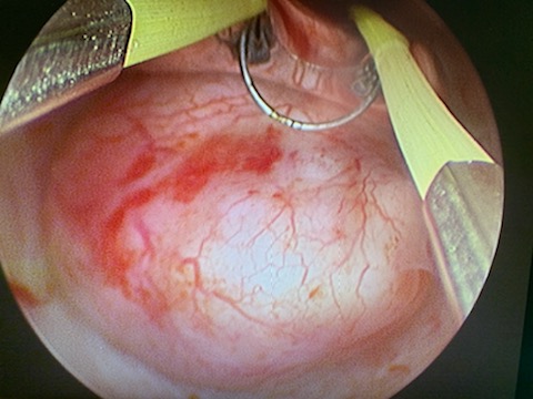 Résection de fibrome sous muqueux