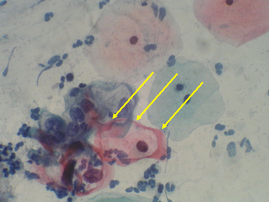 koilocyte