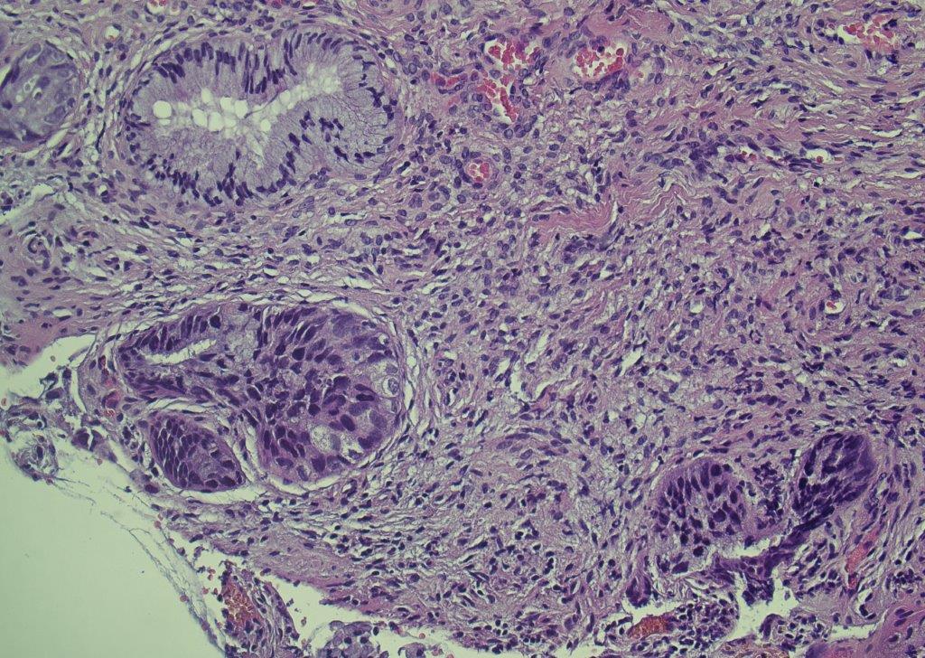 Adénocarcinome in situ du col