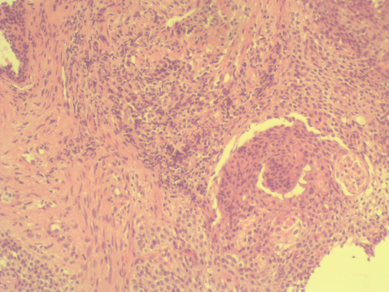 Carcinome épidermoïde invasif du col