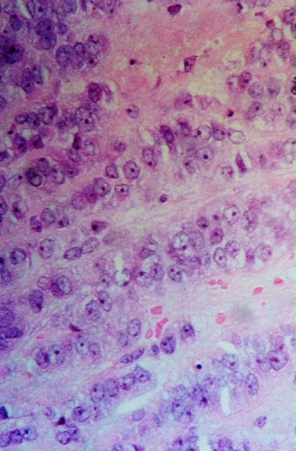 carcinome canalaire invasid du sein