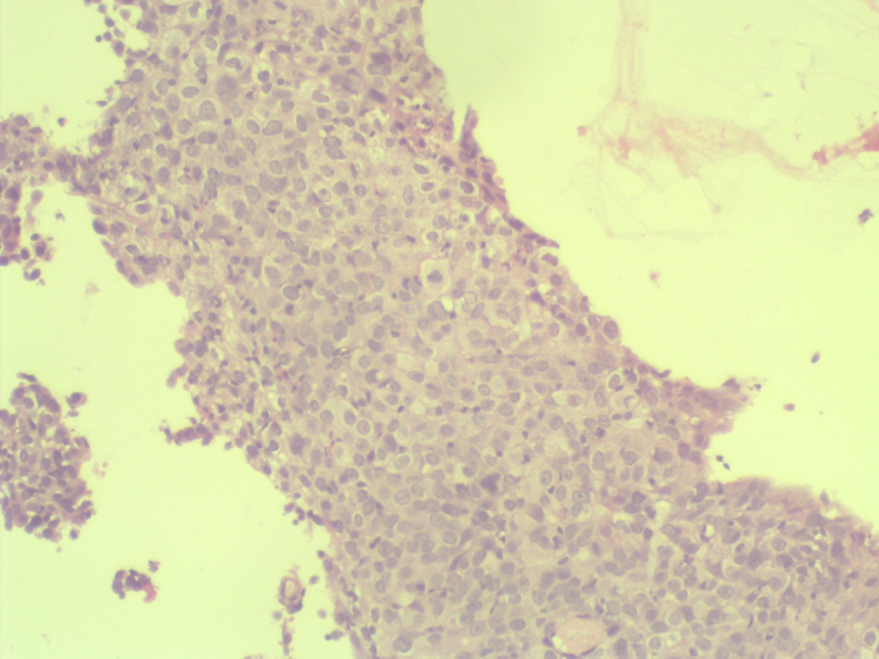 carcinome col uterin 1