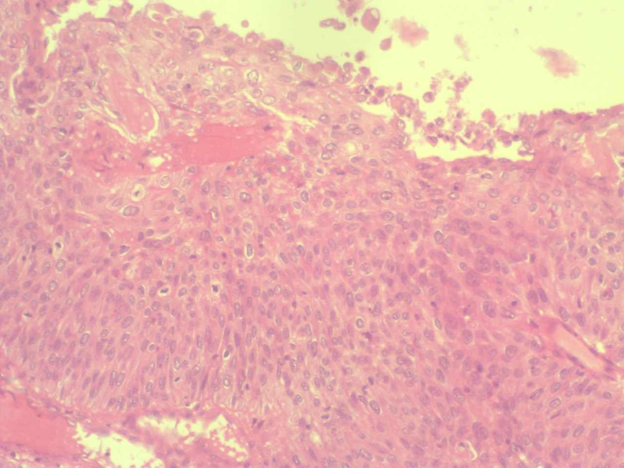 carcinome col uterin 2