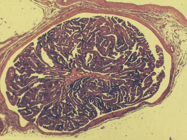 papillome intra galactophorique