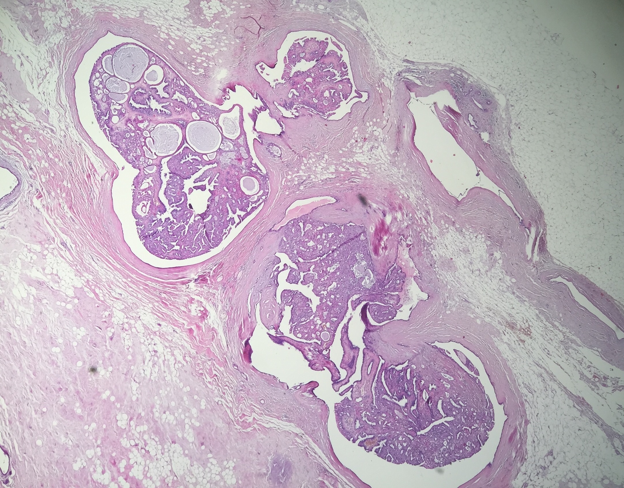 papillome intra galactophorique 2