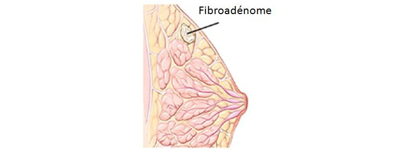 Adénofibrome du sein