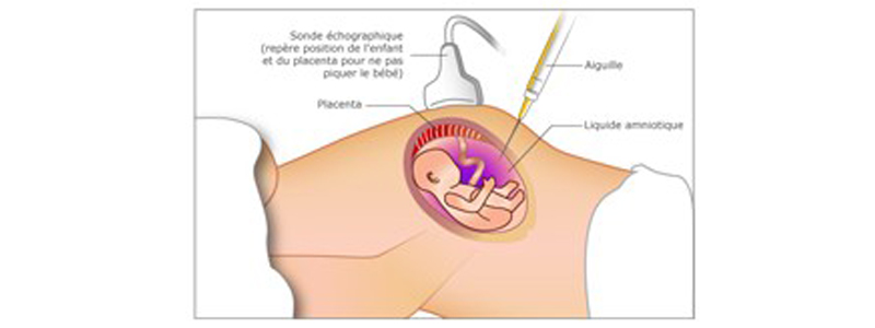 Amniocentèse