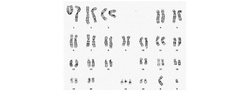 Dépistage trisomie 21