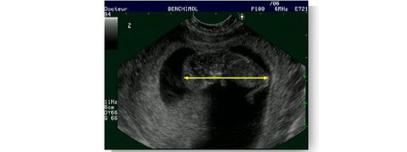 Echographie du premier trimestre