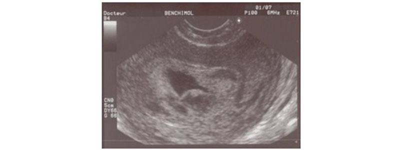 Échographies obstétricales : leur rôle pendant la grossesse
