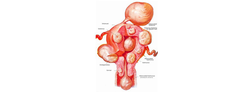 Fibromes utérins