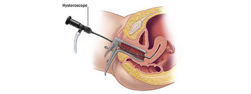 Hystéroscopie opératoire