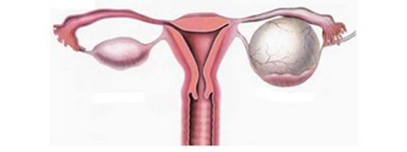 Kyste de l'ovaire - Docteur Benchimol : Gynécologue-obstétricien à ...