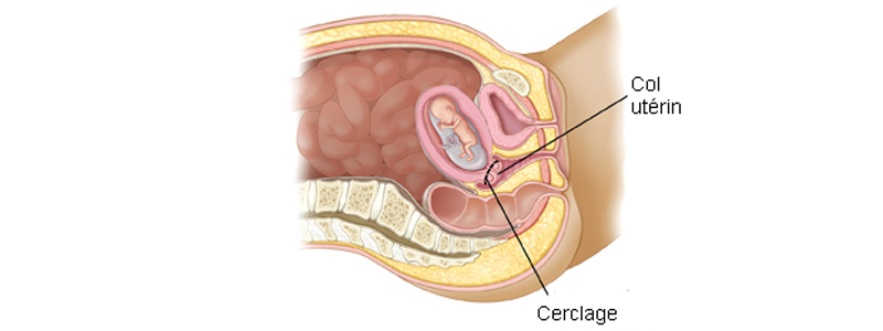 cerclage