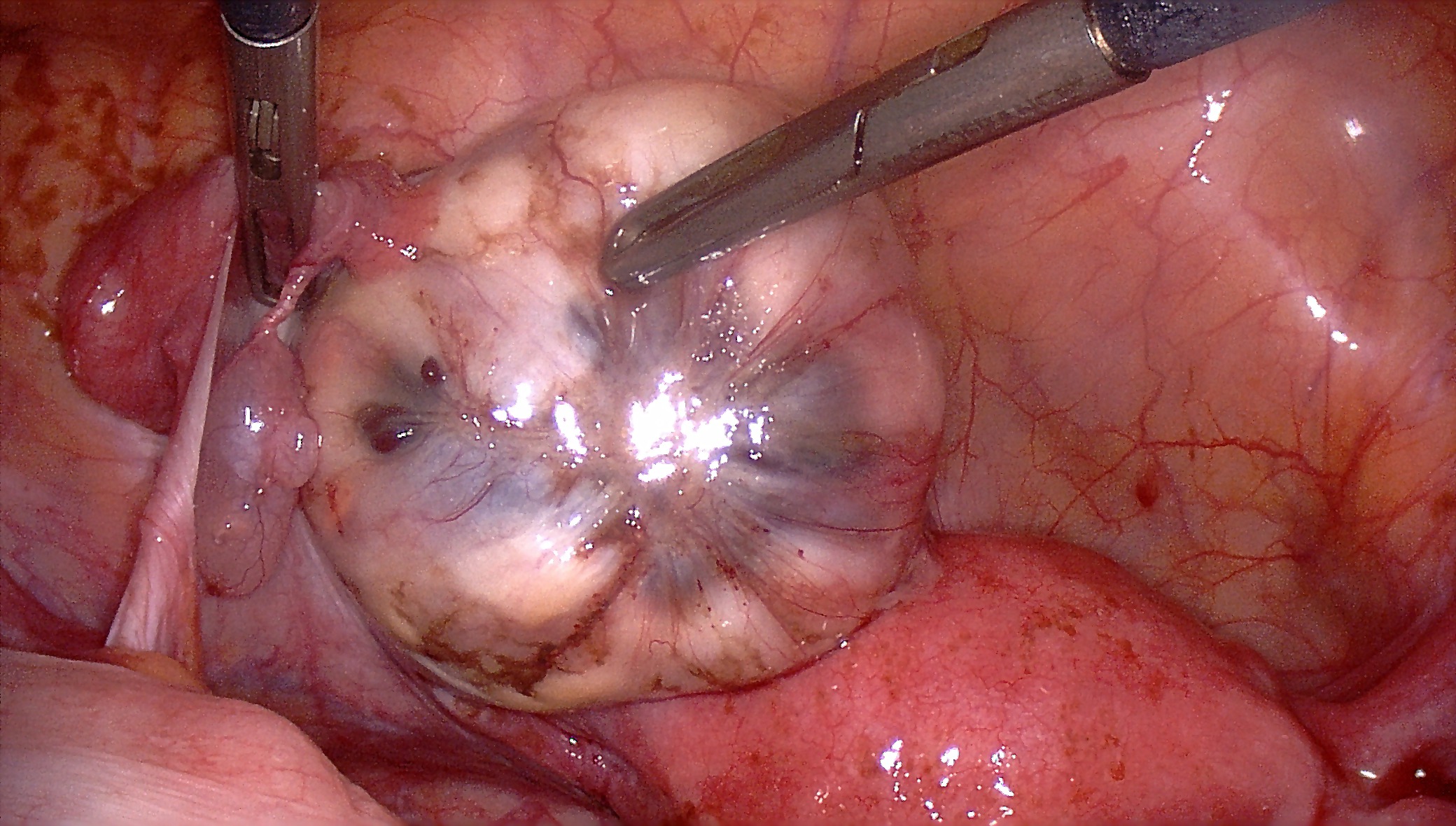 Kystectomie ovarienne - Docteur Benchimol : Gynécologue ...