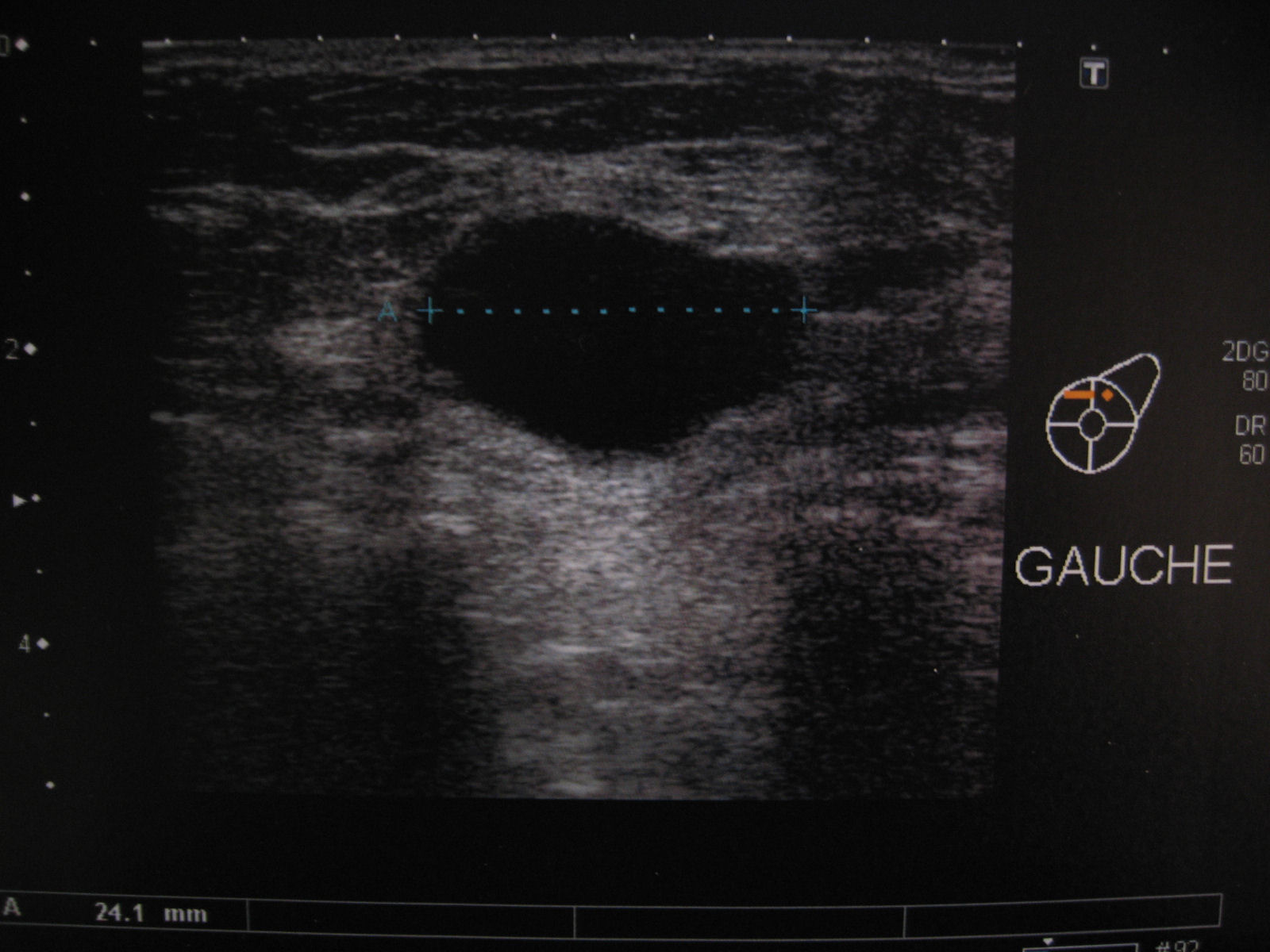 echographie kyste sein