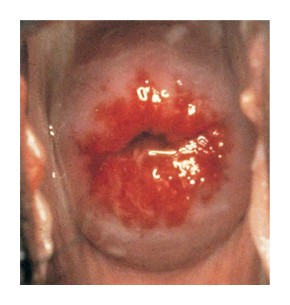 ectropion du col uterin