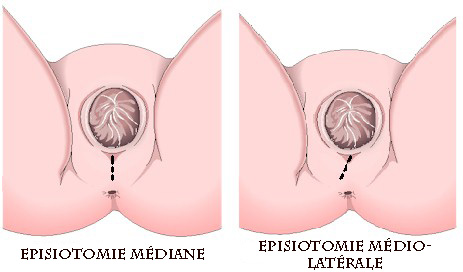 episiotomie