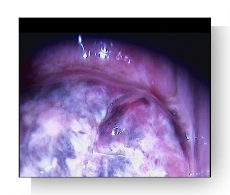 Fibrome utérin - Docteur Benchimol : Gynécologue-obstétricien à ...