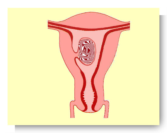 fibrome sous muqueux pedicule