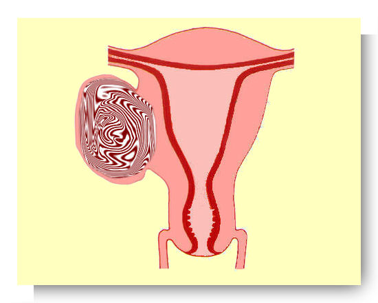 fibrome sous sereux