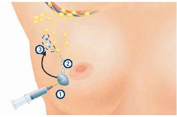 La technique du ganglion sentinelle - Docteur Benchimol ...