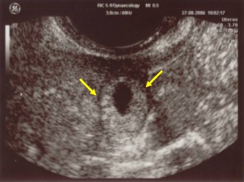 grossesse extra uterine 1