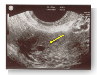 grossesse extra uterine 2