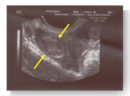 grossesse extra uterine 3