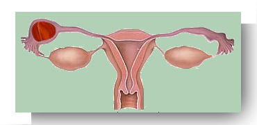 grossesse extra uterine ampullaire