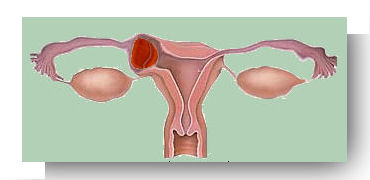 grossesse extra uterine interstitielle