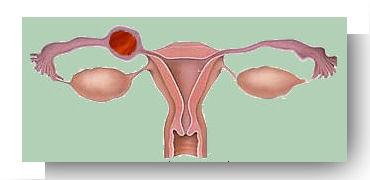 Grossesse extra-utérine - Docteur Benchimol : Gynécologue ...