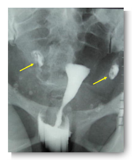 hysterosalpingographie cliche hydrosalpinx bilateral 1