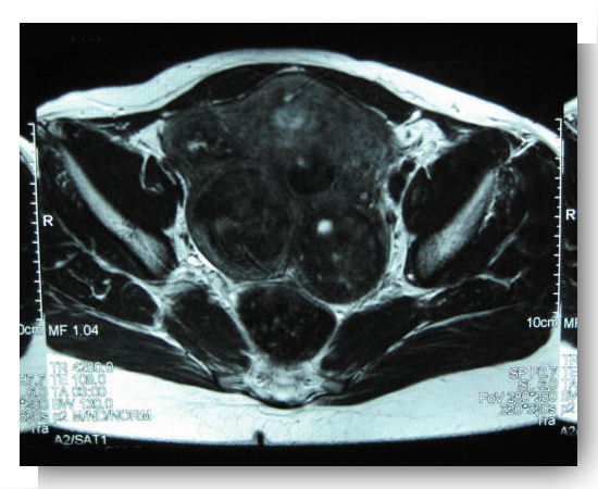 Fibrome utérin - Docteur Benchimol : Gynécologue-obstétricien à ...