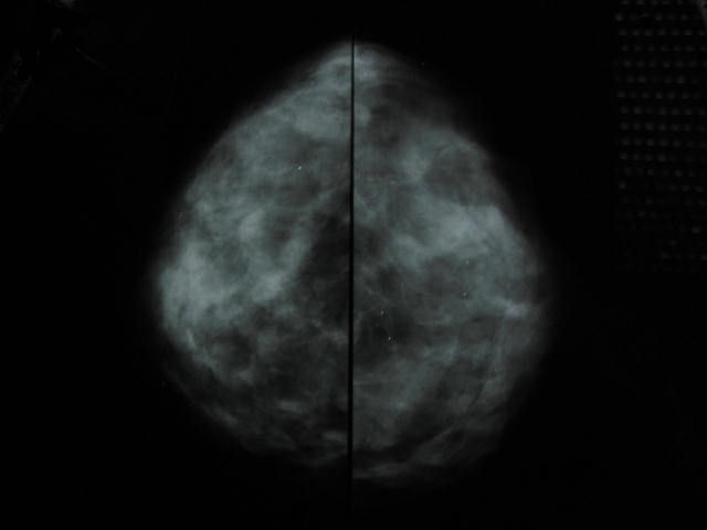 mammographie acr II