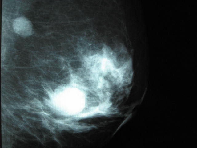 mammographie acr II kyste sein