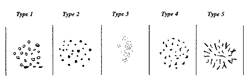 microcalcifications