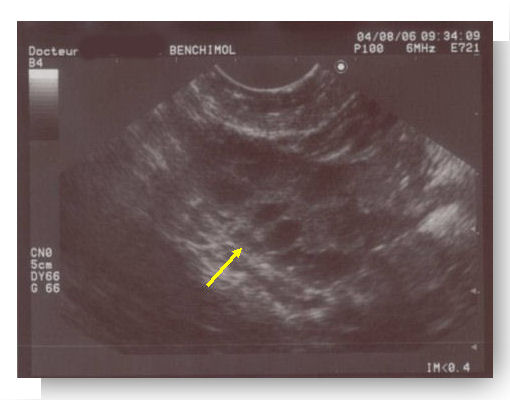 Ovaires polykystiques et syndrome des ovaires polykystiques - Pourquoi  différencier les deux ?