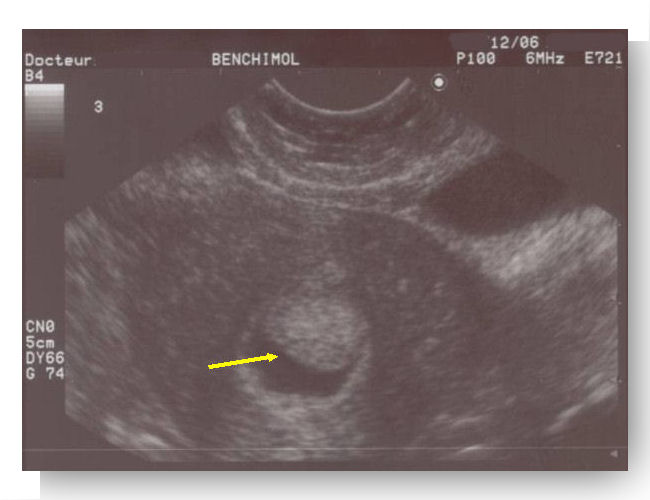 polype hysterosonographie 1