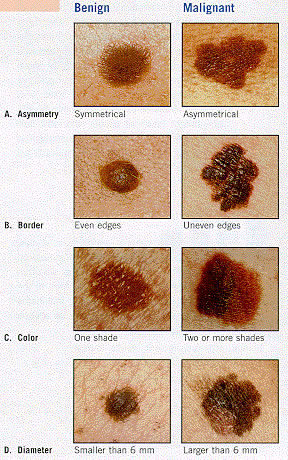 Surveillance des naevus (grains de beauté) pendant la grossesse ...