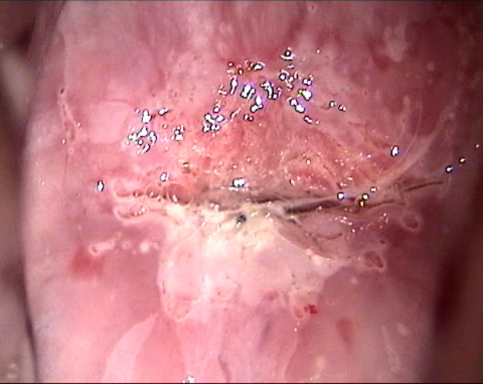 orifices glandulaires acide acetique