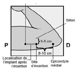 Nexplanon 2