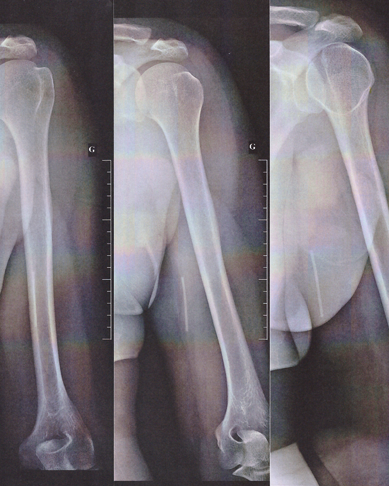 Nexplanon radiographie