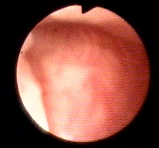 Isthmocele 1